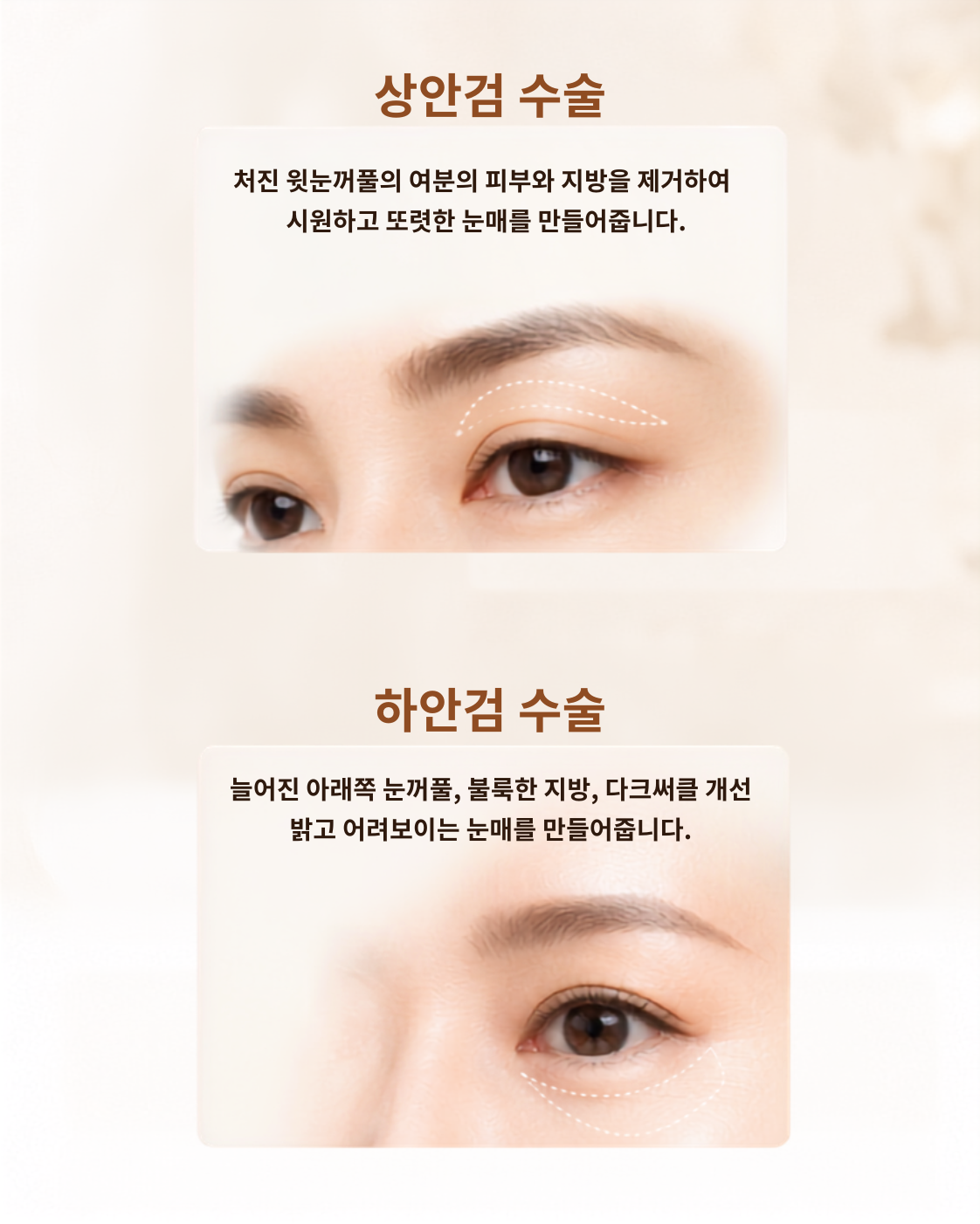 상안검 수술 / 하안검 수술