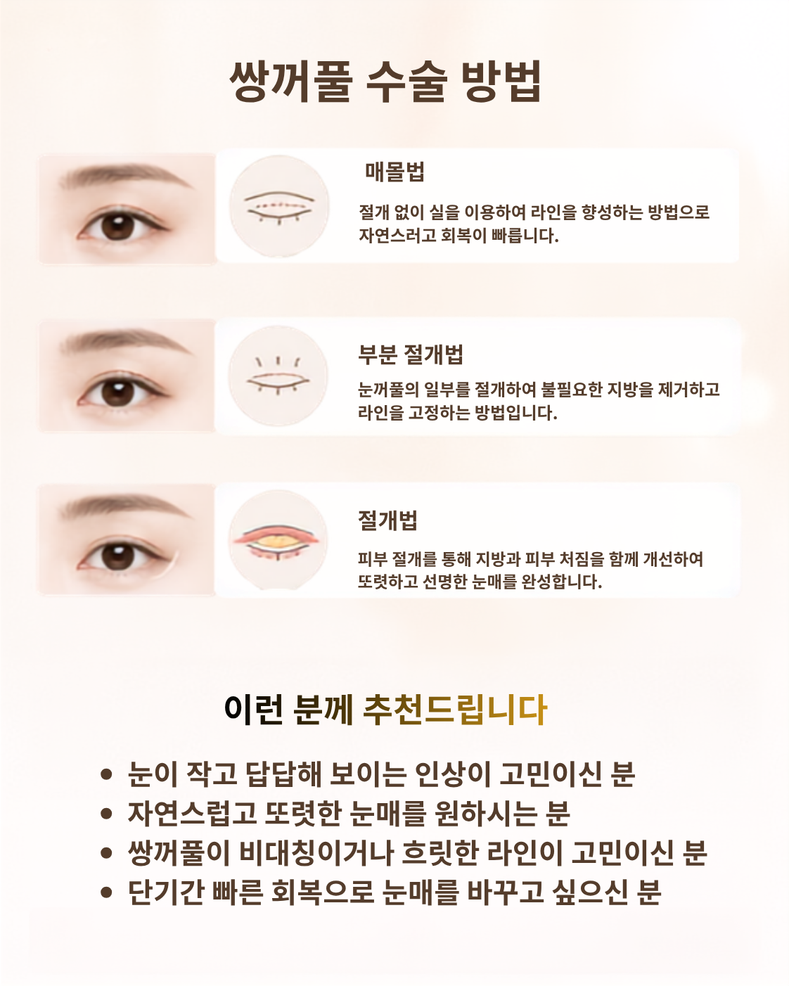 쌍꺼풀 수술 방법 및 추천 대상